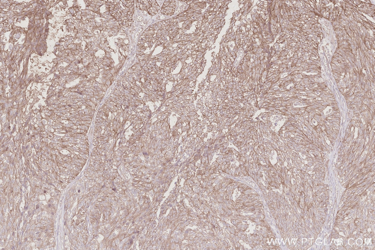 Immunohistochemical analysis of paraffin-embedded human ovary cancer tissue slide using KHC2892 (CEP295 IHC Kit). Immunohistochemical analysis of paraffin-embedded human ovary cancer tissue slide using KHC2892 (CEP295 IHC Kit).