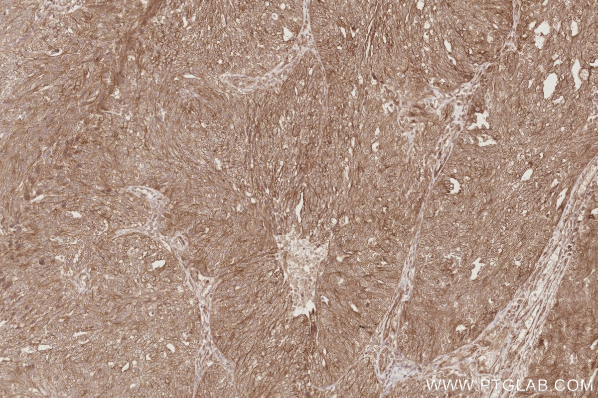 Immunohistochemical analysis of paraffin-embedded human ovary cancer tissue slide using KHC2894 (CEP44 IHC Kit).