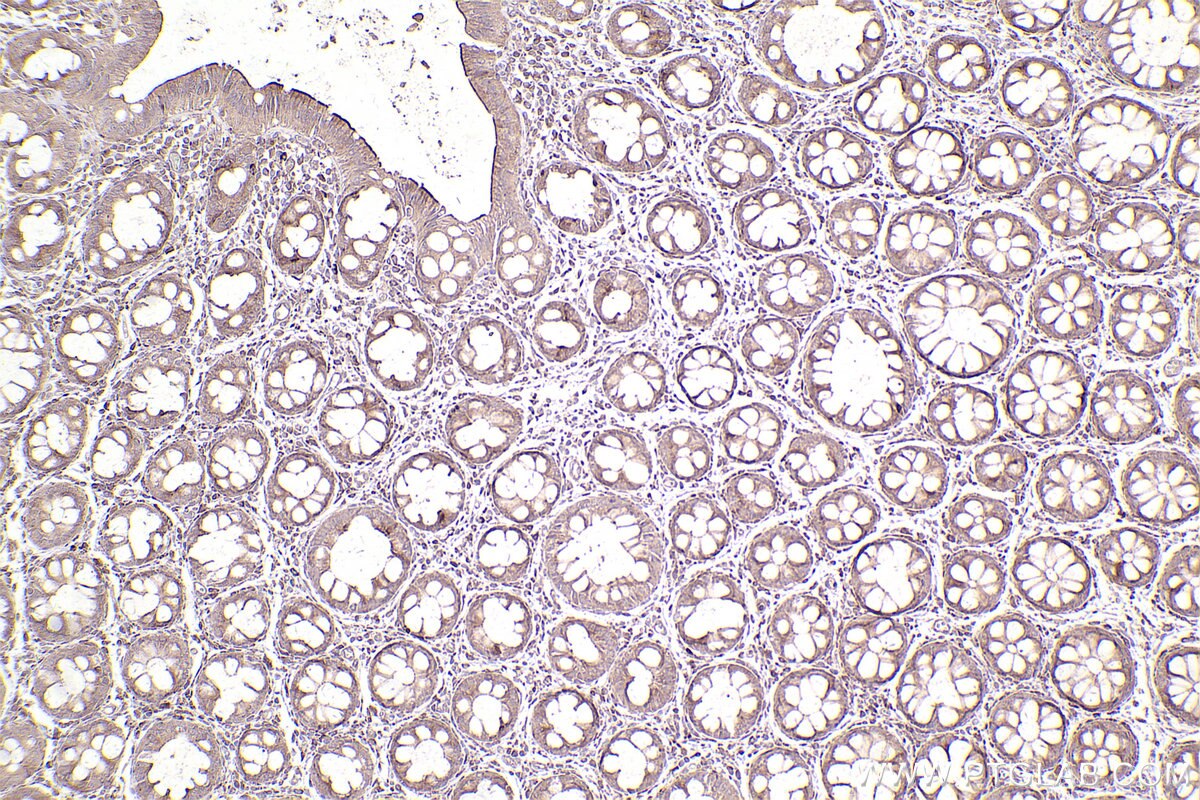 Immunohistochemical analysis of paraffin-embedded human rectal cancer tissue slide using KHC2533 (CEP55 IHC Kit).
