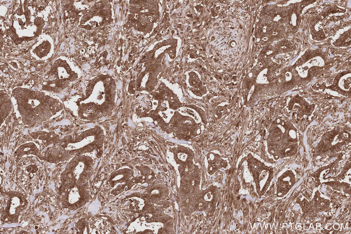 Immunohistochemical analysis of paraffin-embedded human rectal cancer tissue slide using KHC2807 (CEP63 IHC Kit).