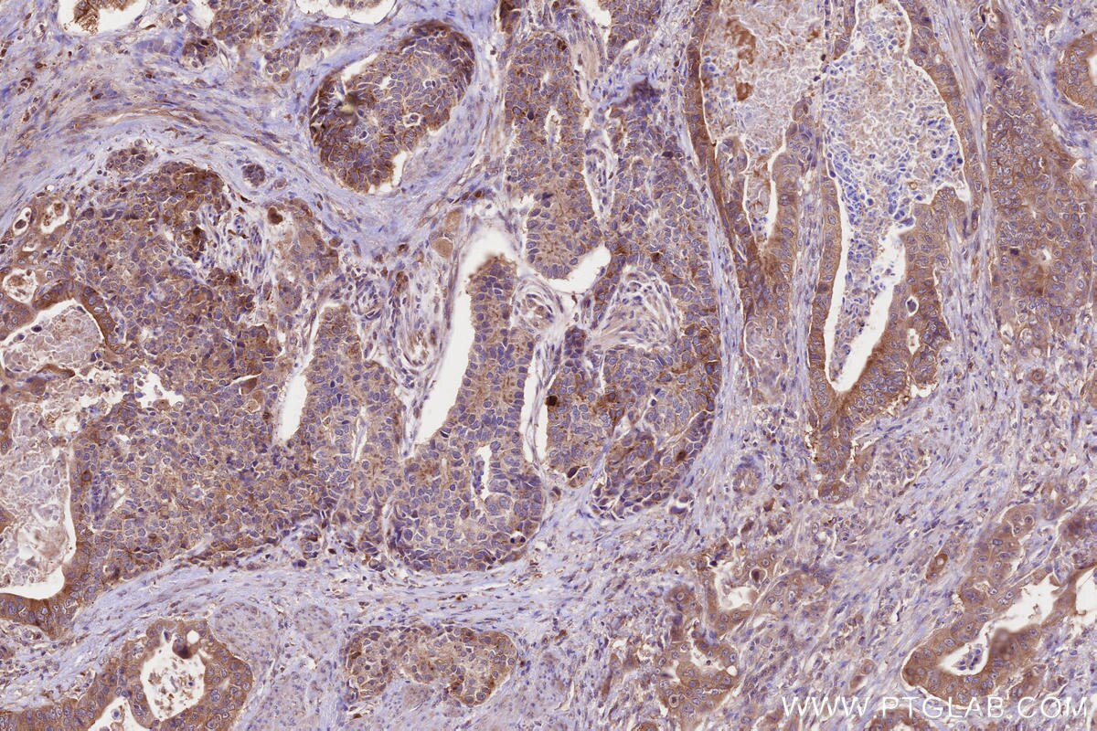 Immunohistochemical analysis of paraffin-embedded human stomach cancer tissue slide using KHC2649 (CEP97 IHC Kit).