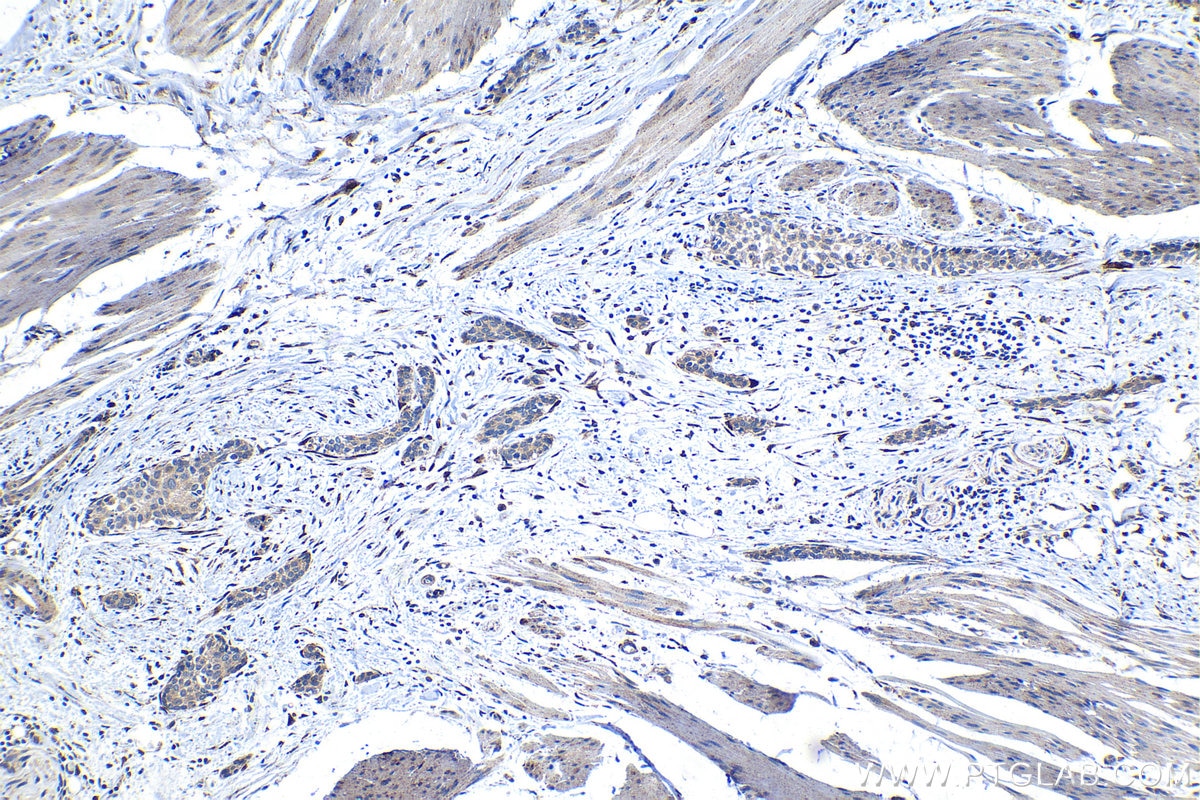 Immunohistochemical analysis of paraffin-embedded human urothelial carcinoma tissue slide using KHC1280 (CERCAM IHC Kit).