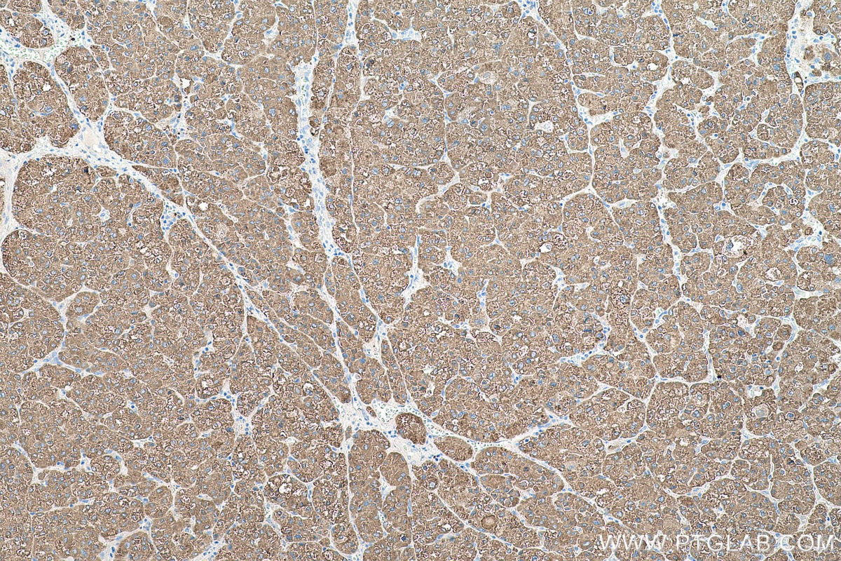 Immunohistochemical analysis of paraffin-embedded human liver cancer tissue slide using KHC0503 (CES1 IHC Kit).