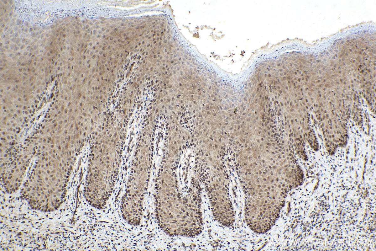 Immunohistochemical analysis of paraffin-embedded human skin cancer tissue slide using KHC1607 (CETN2 IHC Kit).