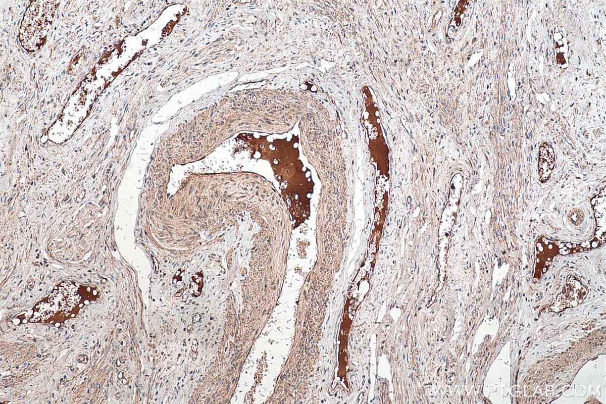 Immunohistochemical analysis of paraffin-embedded human cervical cancer tissue slide using KHC0409 (CFH IHC Kit).