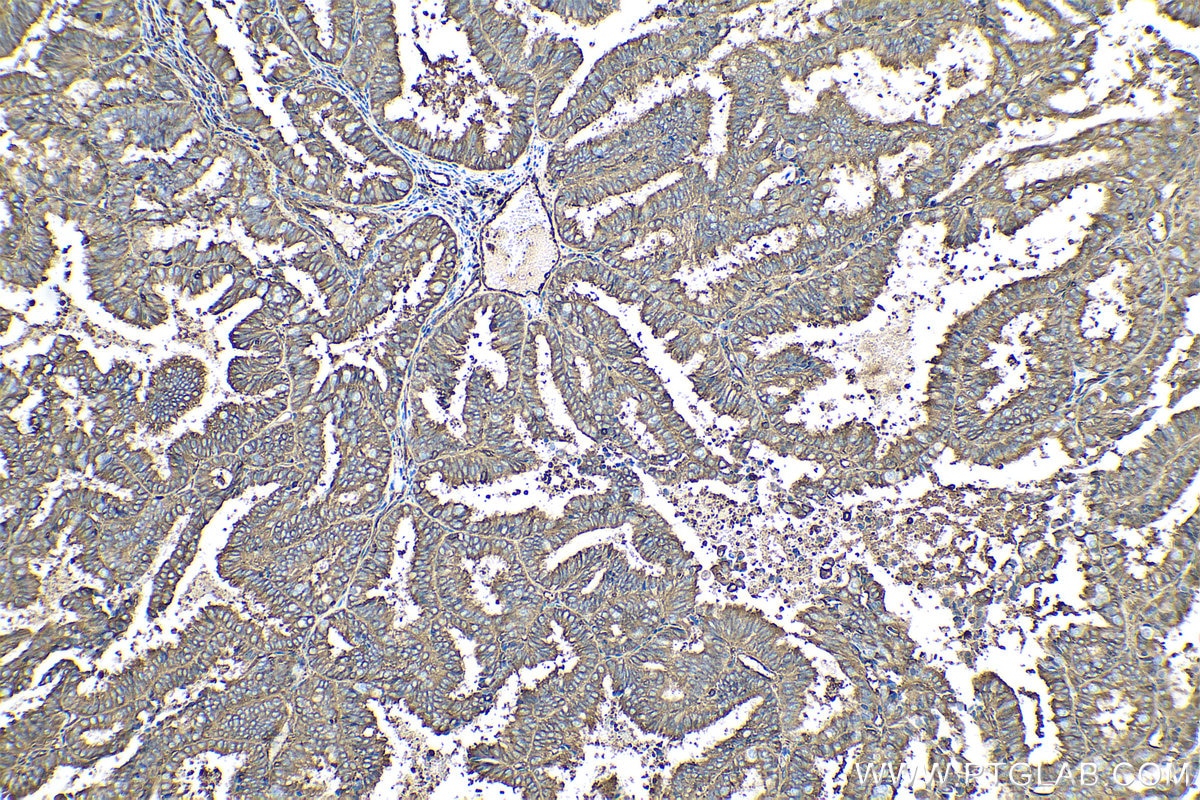 Immunohistochemical analysis of paraffin-embedded human ovary tumor tissue slide using KHC0534 (CFL1 IHC Kit).