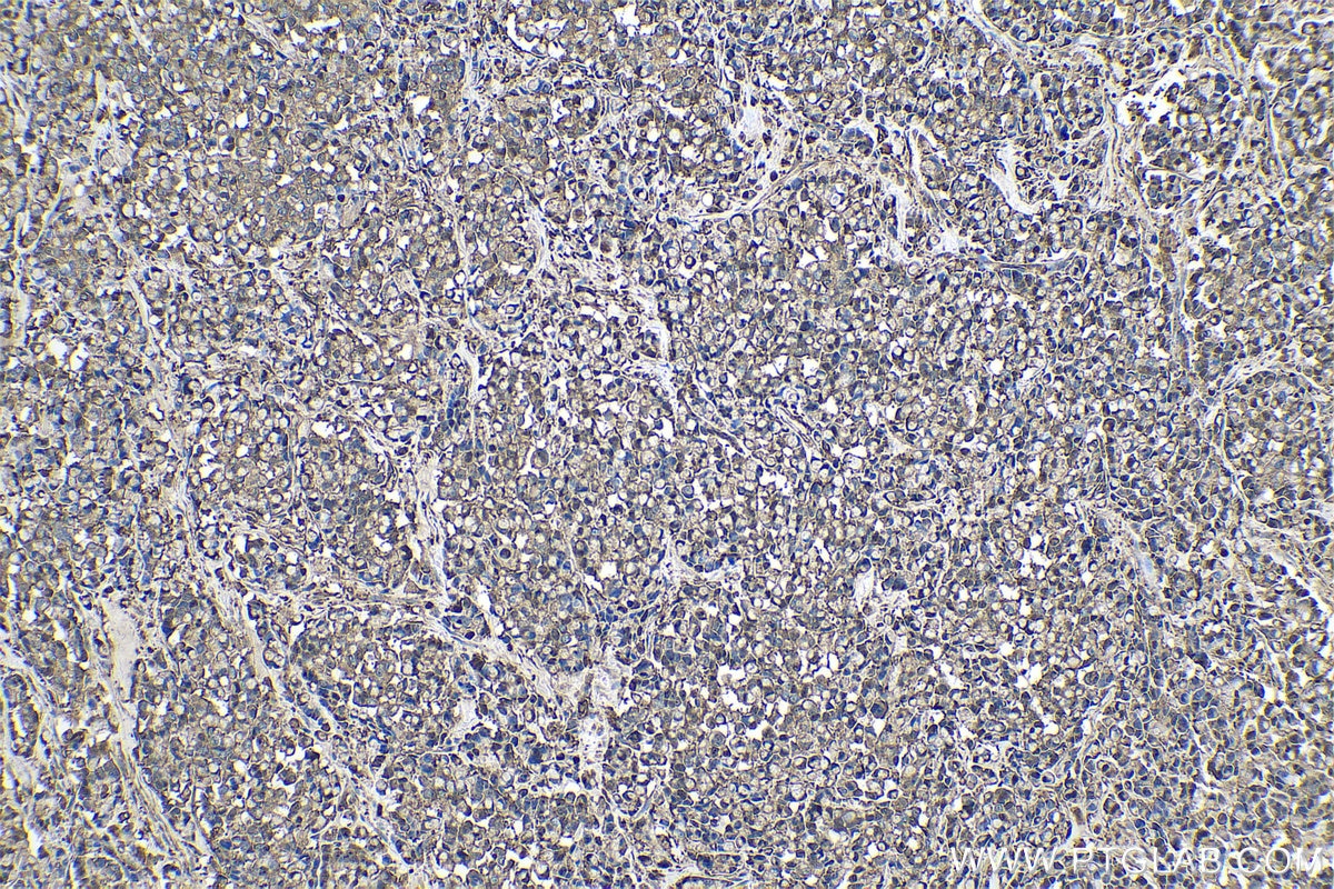 Immunohistochemical analysis of paraffin-embedded human colon cancer tissue slide using KHC0534 (CFL1 IHC Kit).