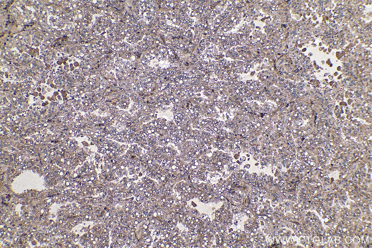 Immunohistochemical analysis of paraffin-embedded human lung cancer tissue slide using KHC0732 (CFL2 IHC Kit).