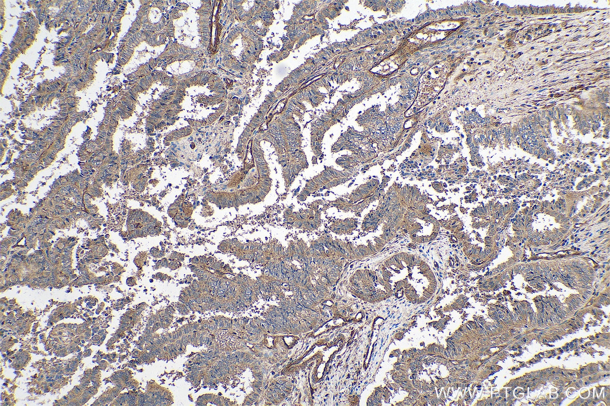Immunohistochemical analysis of paraffin-embedded human ovary tumor tissue slide using KHC0732 (CFL2 IHC Kit).