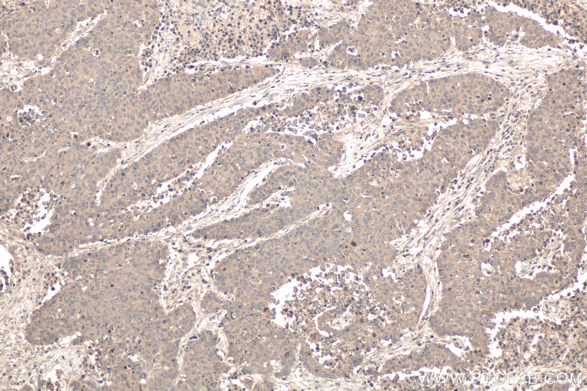 Immunohistochemical analysis of paraffin-embedded human colon cancer tissue slide using KHC0610 (CFLAR/FLIP IHC Kit).