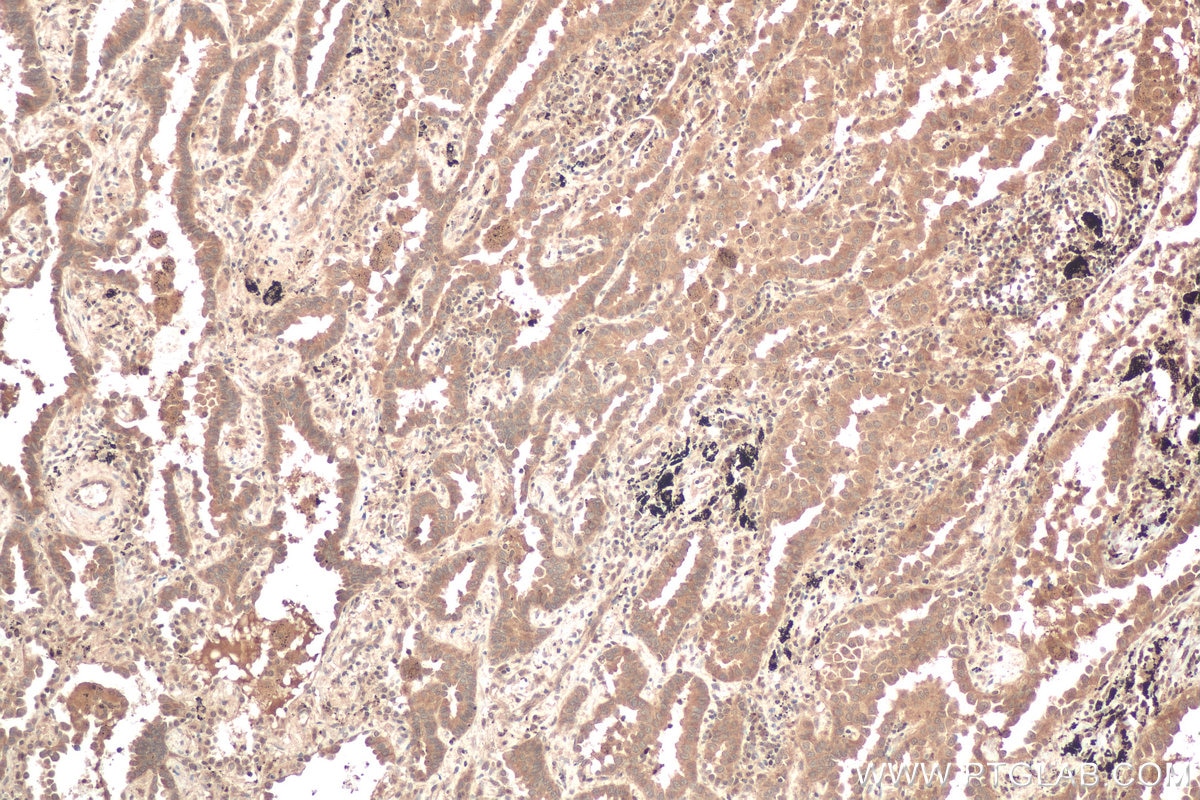 Immunohistochemical analysis of paraffin-embedded human lung cancer tissue slide using KHC0610 (CFLAR/FLIP IHC Kit).