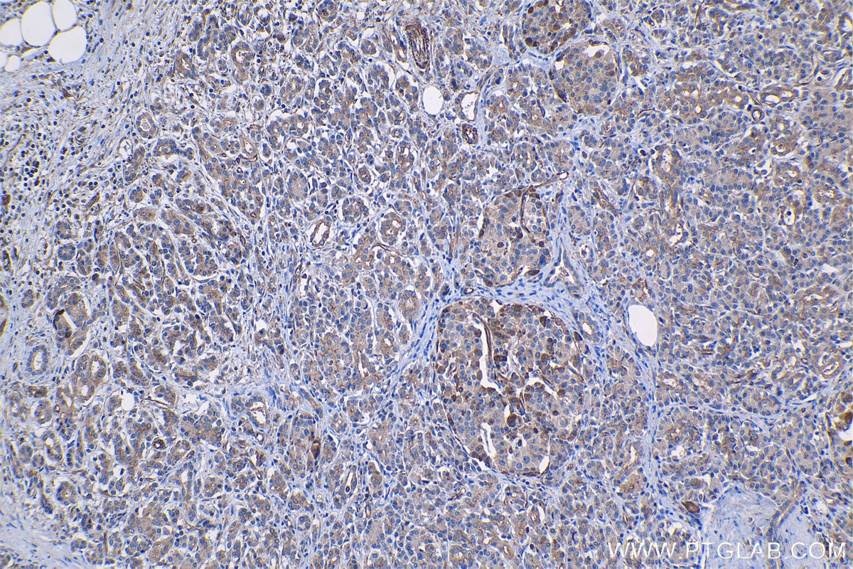 Immunohistochemical analysis of paraffin-embedded human pancreas cancer tissue slide using KHC1322 (CFTR IHC Kit).