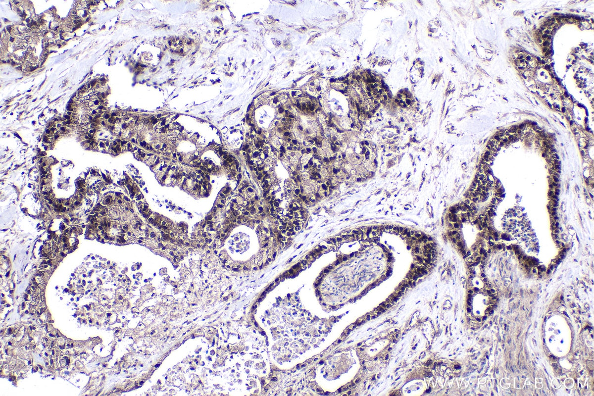 Immunohistochemical analysis of paraffin-embedded human pancreas cancer tissue slide using KHC1700 (CHAF1B IHC Kit).