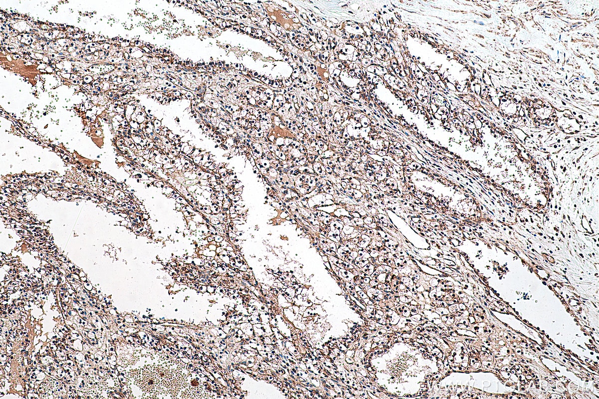Immunohistochemical analysis of paraffin-embedded human renal cell carcinoma tissue slide using KHC0410 (CHCHD2 IHC Kit).