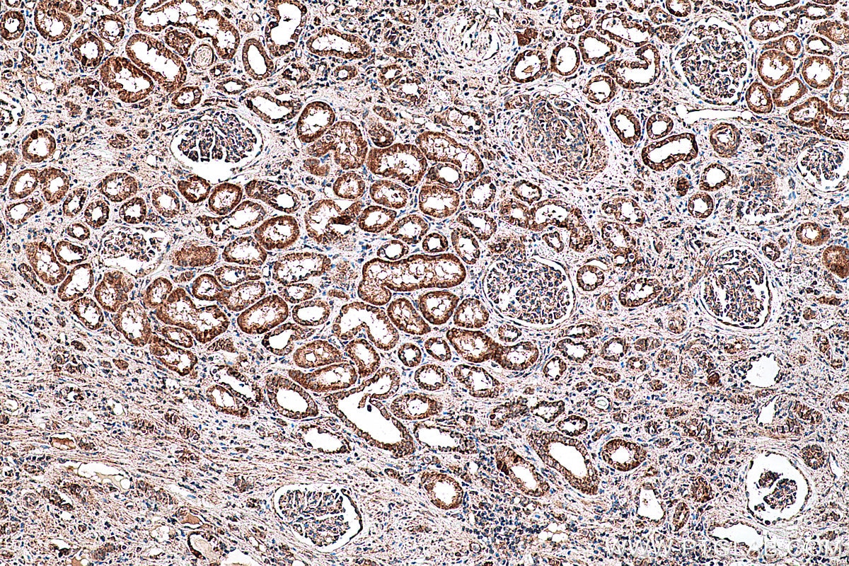 Immunohistochemical analysis of paraffin-embedded human renal cell carcinoma(NAT) tissue slide using KHC0410 (CHCHD2 IHC Kit).