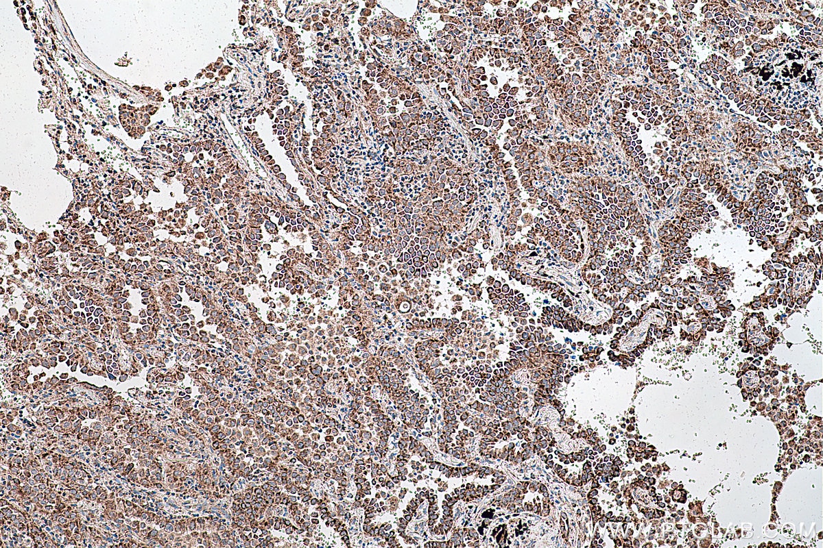 Immunohistochemical analysis of paraffin-embedded human lung cancer tissue slide using KHC0410 (CHCHD2 IHC Kit).