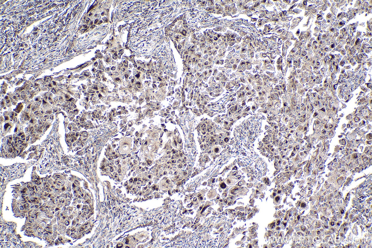 Immunohistochemical analysis of paraffin-embedded human lung cancer tissue slide using KHC1970 (CHCHD3 IHC Kit).