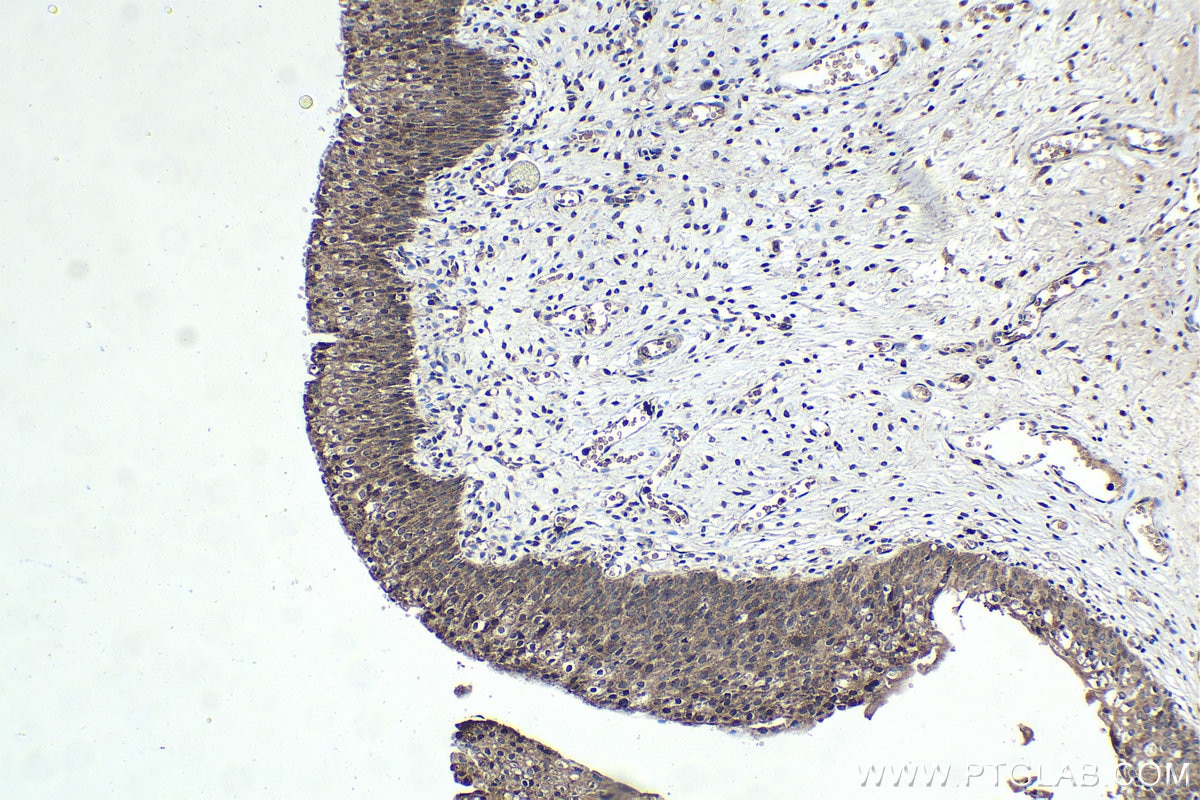 Immunohistochemical analysis of paraffin-embedded human urothelial carcinoma tissue slide using KHC1425 (CHD1 IHC Kit).
