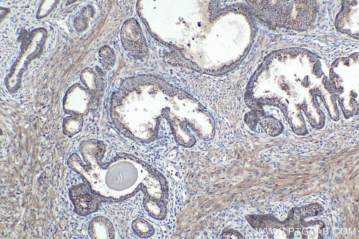Immunohistochemical analysis of paraffin-embedded human prostate cancer tissue slide using KHC1425 (CHD1 IHC Kit).