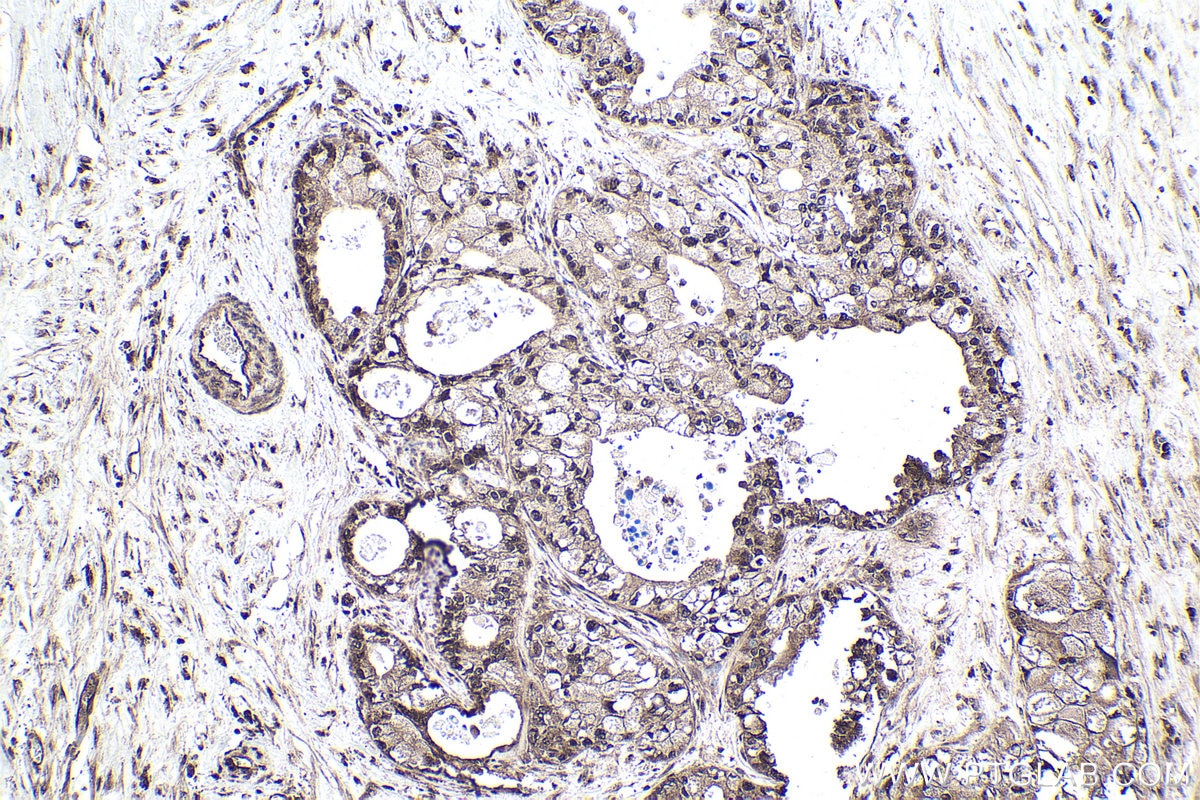 Immunohistochemical analysis of paraffin-embedded human pancreas cancer tissue slide using KHC1694 (CHD3 IHC Kit).