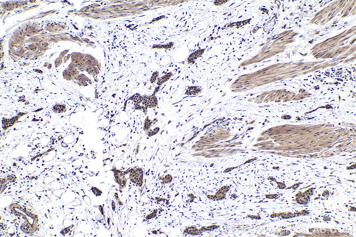 Immunohistochemical analysis of paraffin-embedded human urothelial carcinoma tissue slide using KHC1694 (CHD3 IHC Kit).