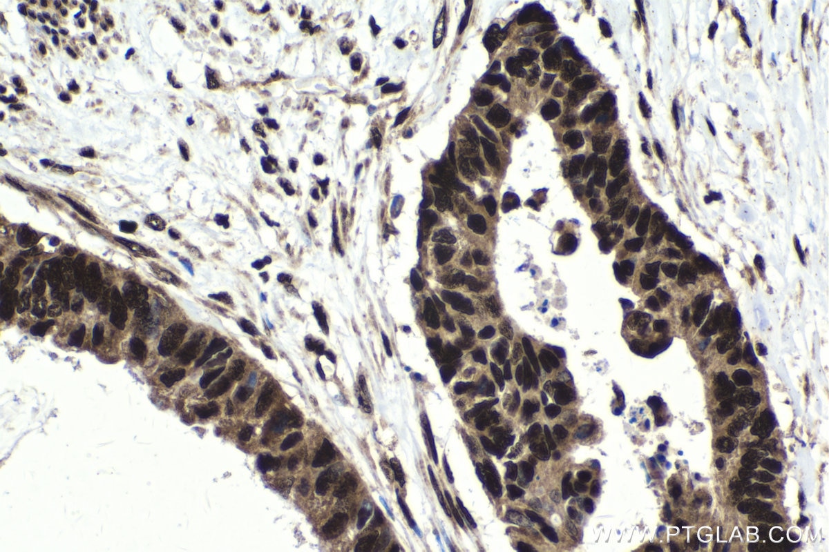 Immunohistochemical analysis of paraffin-embedded human urothelial carcinoma tissue slide using KHC1737 (CHD4 IHC Kit).