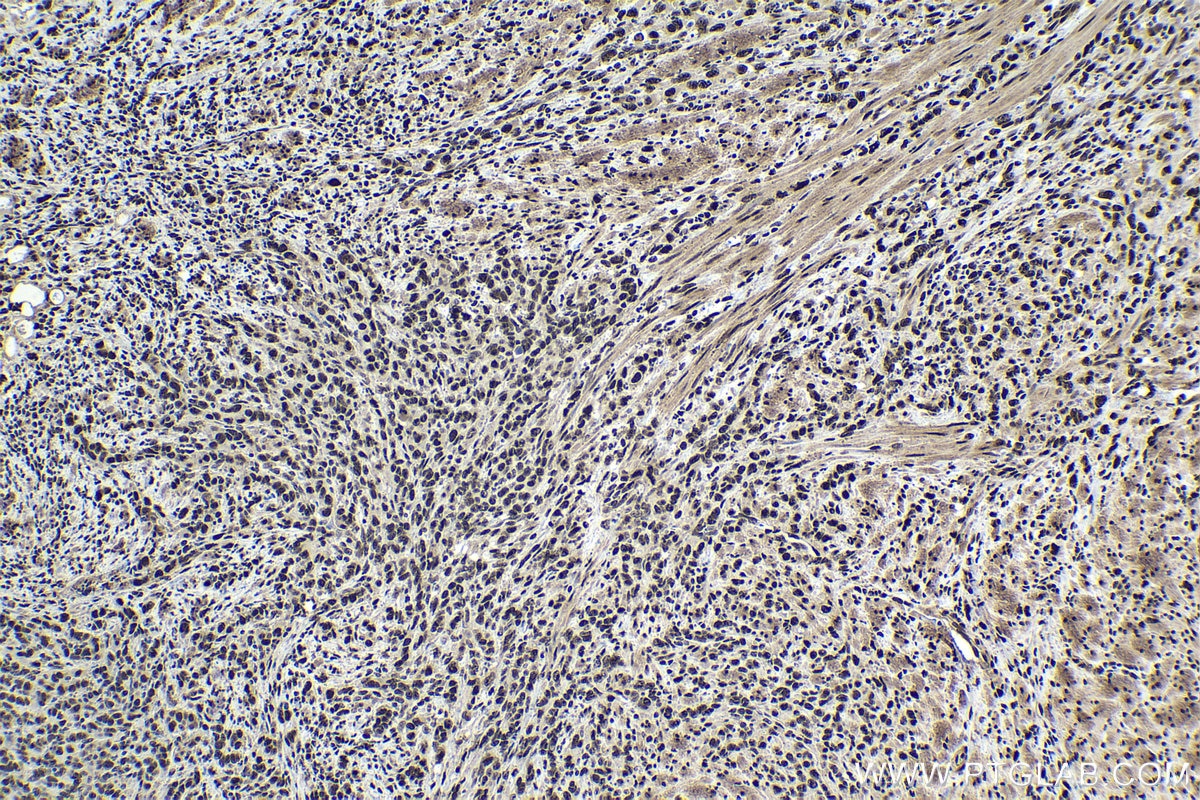 Immunohistochemical analysis of paraffin-embedded human stomach cancer tissue slide using KHC1737 (CHD4 IHC Kit).