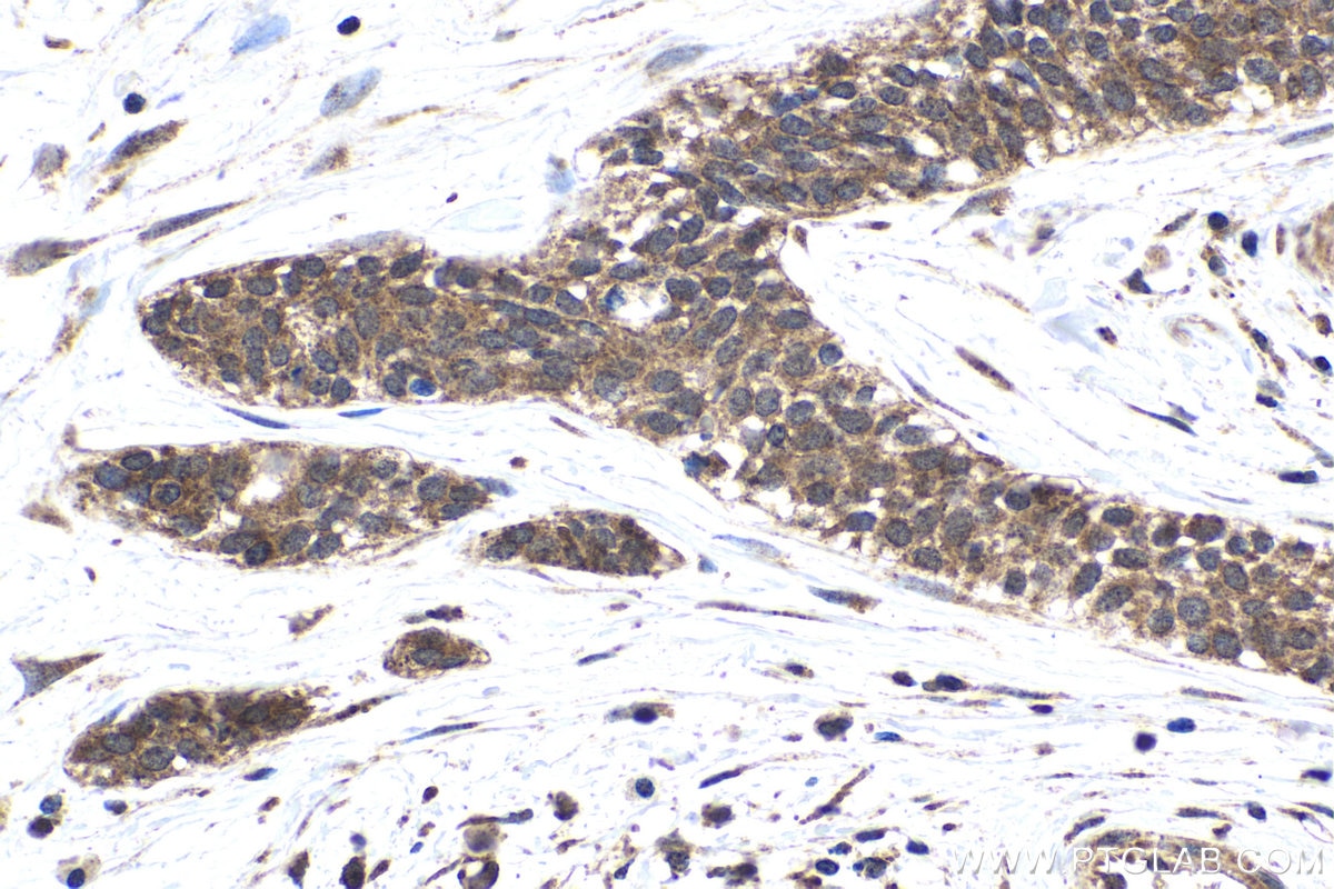 Immunohistochemical analysis of paraffin-embedded human urothelial carcinoma tissue slide using KHC1769 (CHD9 IHC Kit).