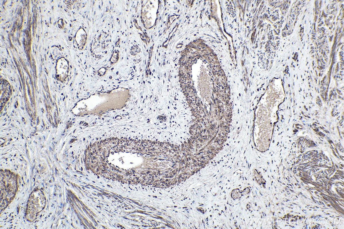 Immunohistochemical analysis of paraffin-embedded human cervical cancer tissue slide using KHC1769 (CHD9 IHC Kit).