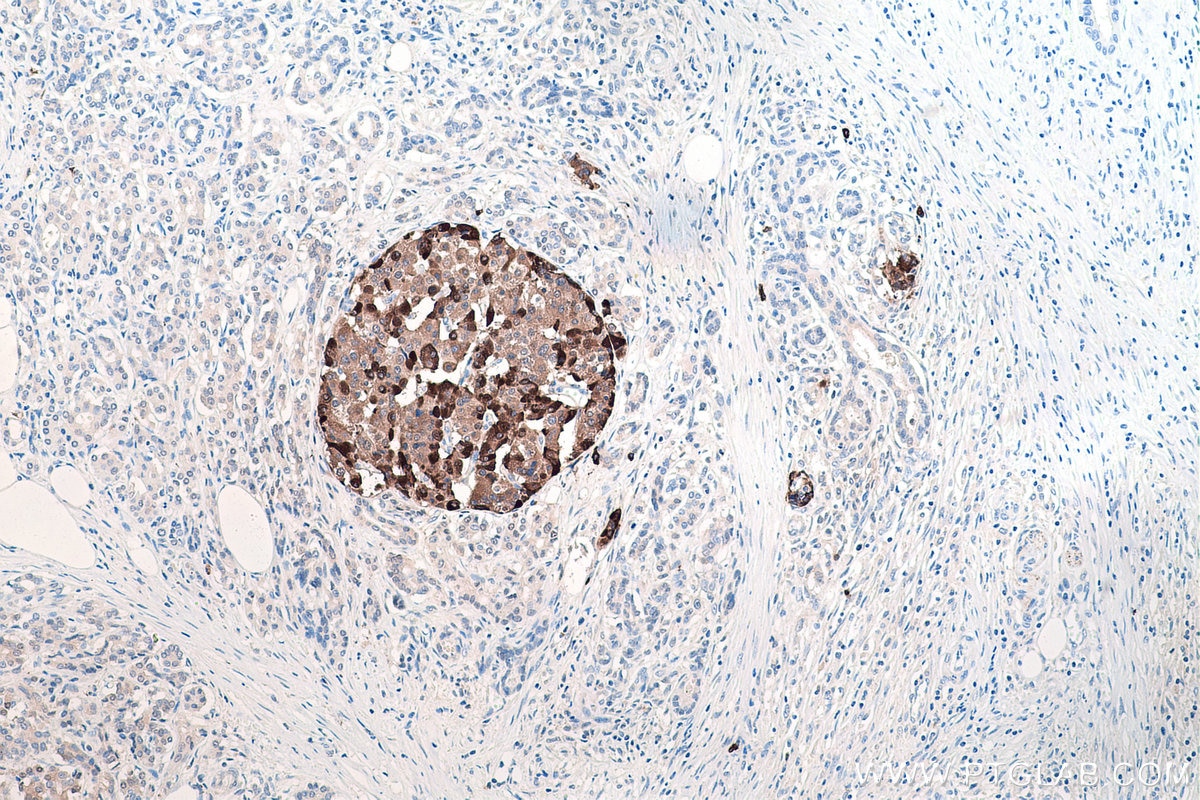 Immunohistochemical analysis of paraffin-embedded human pancreas cancer tissue slide using KHC0211 (Chromogranin B IHC Kit).
