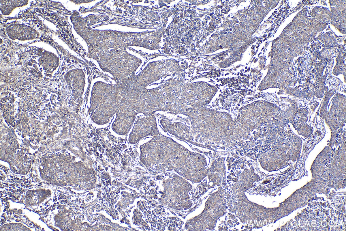 Immunohistochemical analysis of paraffin-embedded human lung cancer tissue slide using KHC1427 (CHK1 IHC Kit).