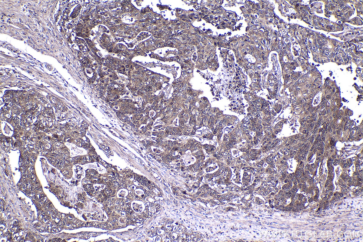 Immunohistochemical analysis of paraffin-embedded human stomach cancer tissue slide using KHC1427 (CHK1 IHC Kit).