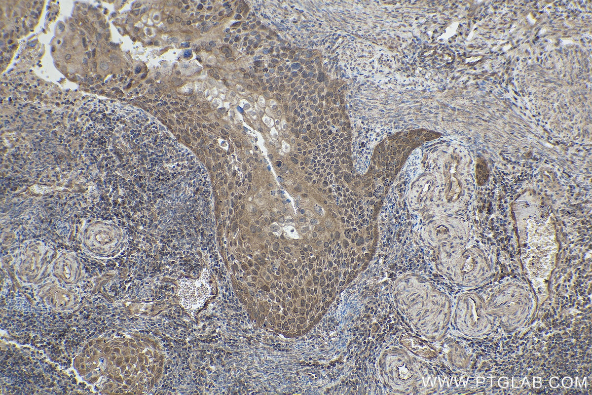 Immunohistochemical analysis of paraffin-embedded human cervical cancer tissue slide using KHC1951 (CHMP1A IHC Kit).