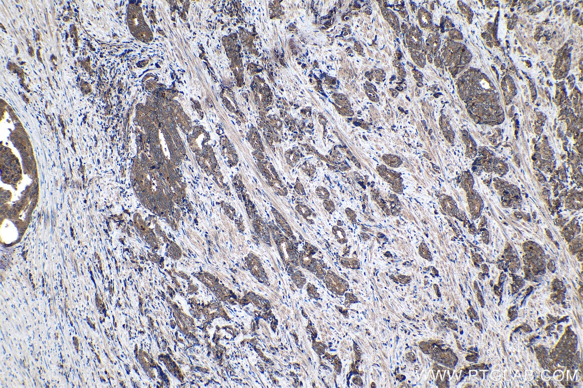 Immunohistochemical analysis of paraffin-embedded human prostate cancer tissue slide using KHC1455 (CHMP2A IHC Kit).