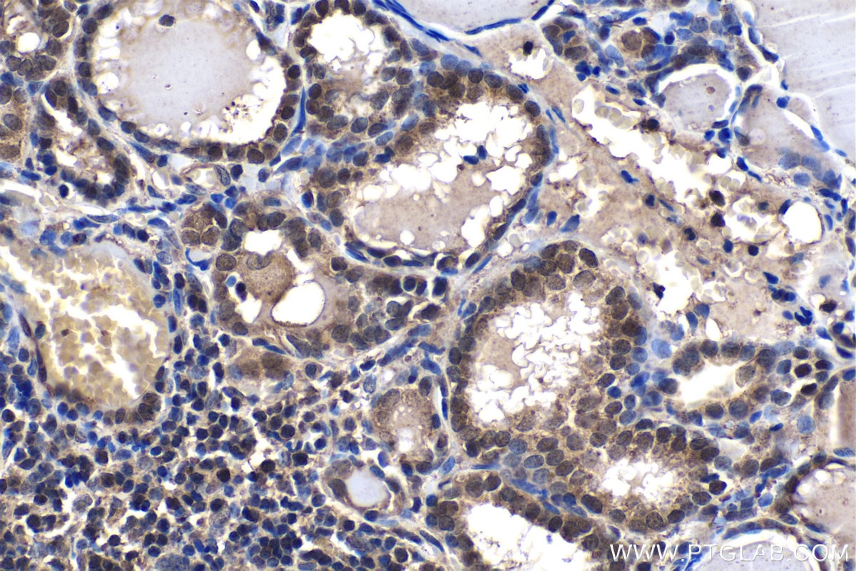 Immunohistochemical analysis of paraffin-embedded human thyroid cancer tissue slide using KHC1455 (CHMP2A IHC Kit).