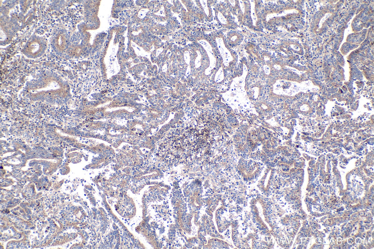 Immunohistochemical analysis of paraffin-embedded human endometrial cancer tissue slide using KHC1930 (CHMP4B IHC Kit).