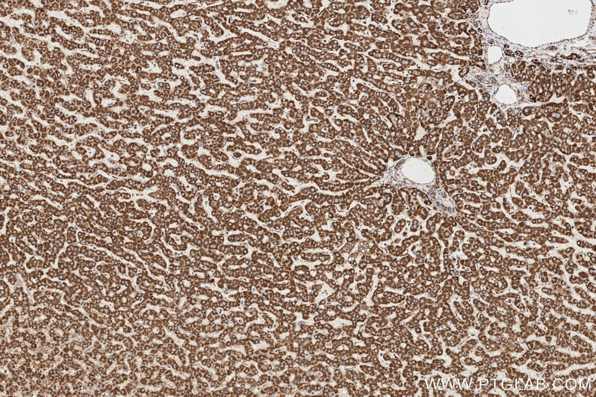 Immunohistochemical analysis of paraffin-embedded human hepatocirrhosis tissue slide using KHC3297 (CHST13 IHC Kit). Immunohistochemical analysis of paraffin-embedded human hepatocirrhosis tissue slide using KHC3297 (CHST13 IHC Kit).