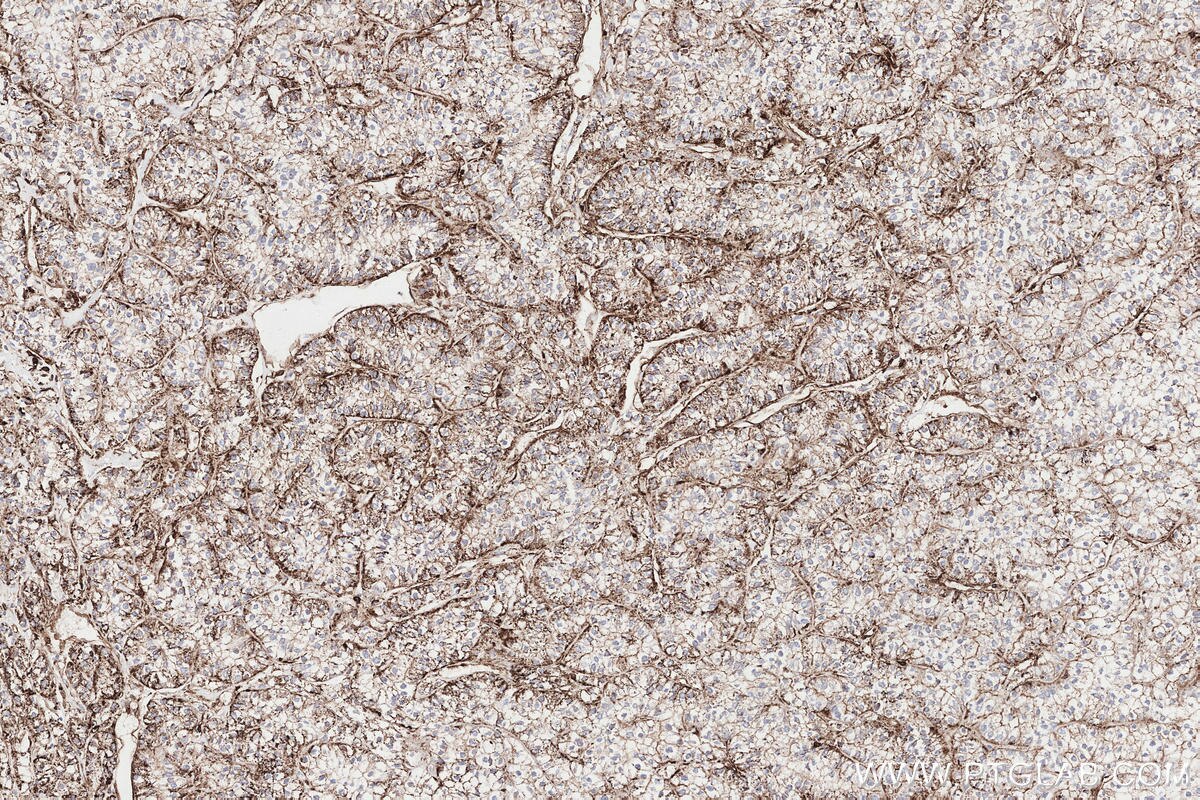 Immunohistochemical analysis of paraffin-embedded human renal cell carcinoma tissue slide using KHC3297 (CHST13 IHC Kit). Immunohistochemical analysis of paraffin-embedded human renal cell carcinoma tissue slide using KHC3297 (CHST13 IHC Kit).