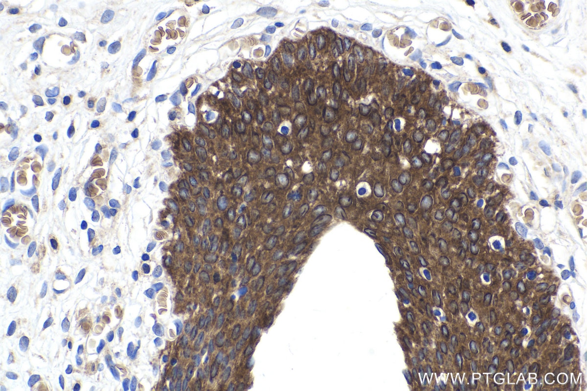 Immunohistochemical analysis of paraffin-embedded human urothelial carcinoma tissue slide using KHC1898 (CIB1 IHC Kit).