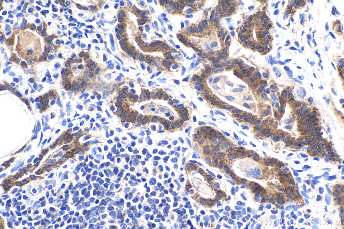 Immunohistochemical analysis of paraffin-embedded human thyroid cancer tissue slide using KHC1898 (CIB1 IHC Kit).