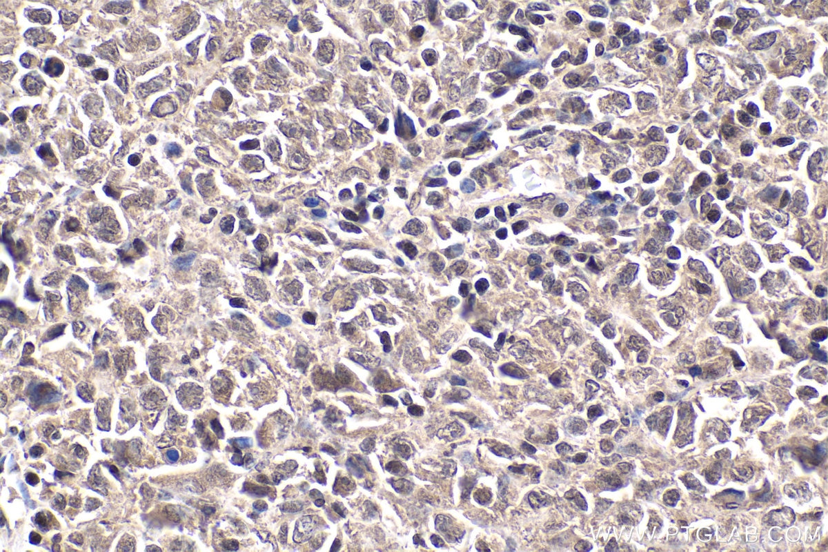 Immunohistochemical analysis of paraffin-embedded human malignant melanoma tissue slide using KHC1867 (CIDEC IHC Kit).