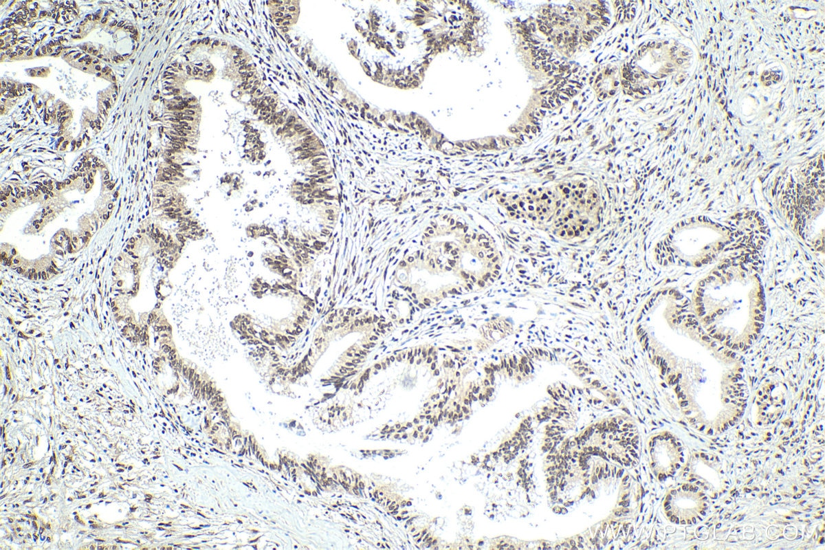 Immunohistochemical analysis of paraffin-embedded human pancreas cancer tissue slide using KHC1218 (CIRBP IHC Kit).