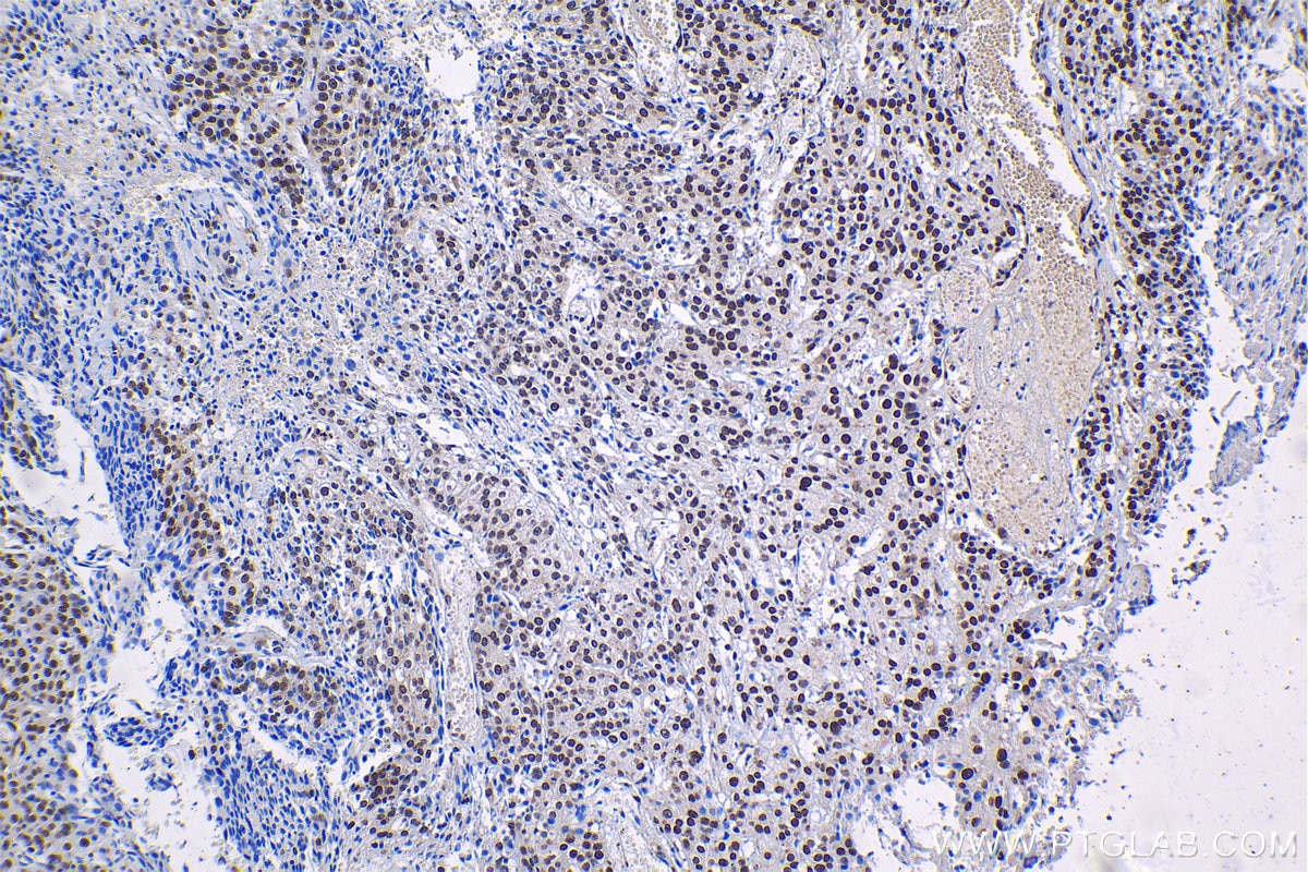 Immunohistochemical analysis of paraffin-embedded human cervical cancer tissue slide using KHC1218 (CIRBP IHC Kit).