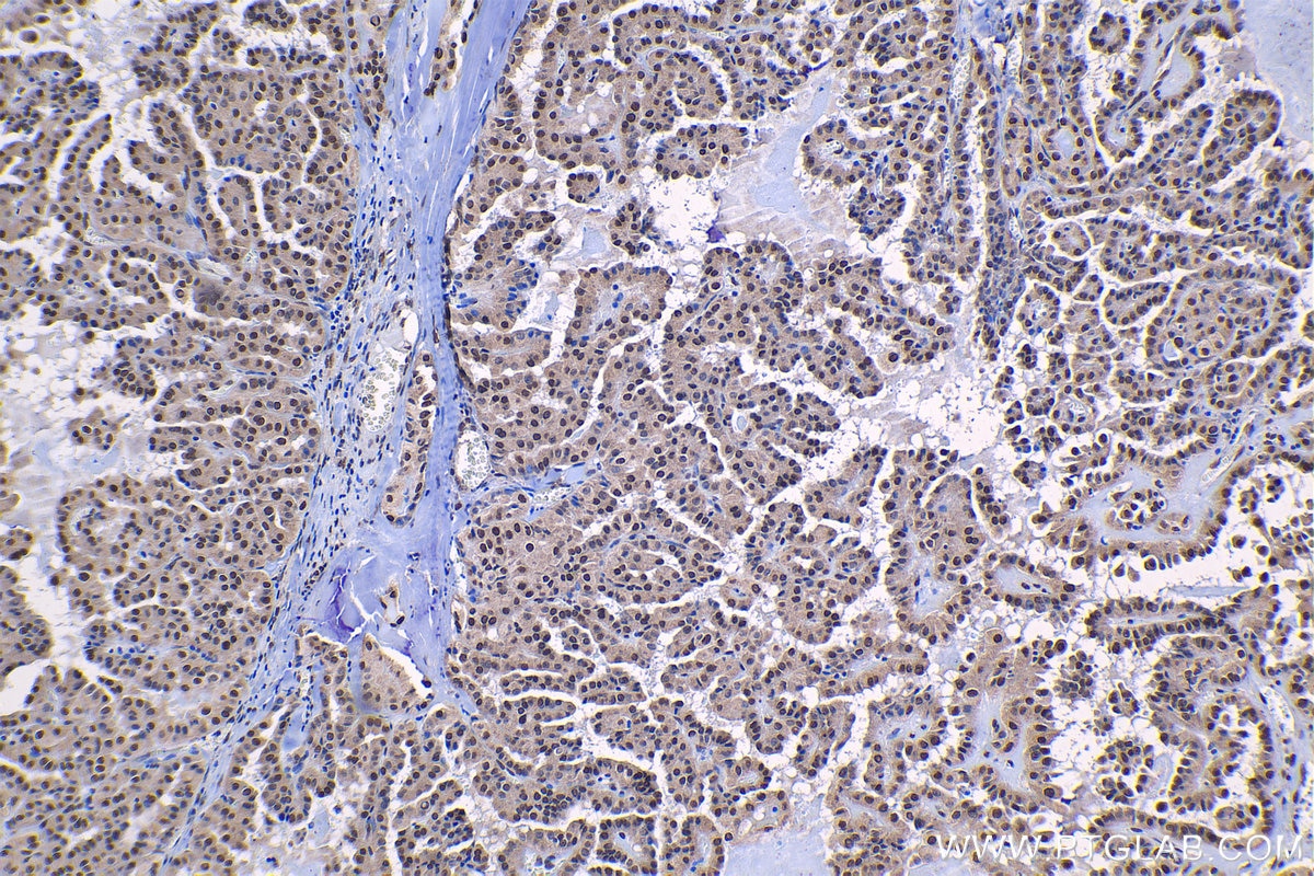Immunohistochemical analysis of paraffin-embedded human thyroid cancer tissue slide using KHC1218 (CIRBP IHC Kit).