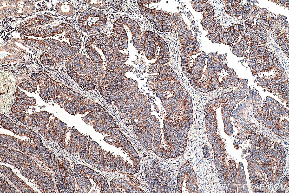 Immunohistochemical analysis of paraffin-embedded human colon cancer tissue slide using KHC0295 (CITED1 IHC Kit).