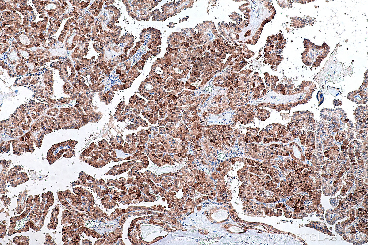 Immunohistochemical analysis of paraffin-embedded human thyroid cancer tissue slide using KHC0295 (CITED1 IHC Kit).