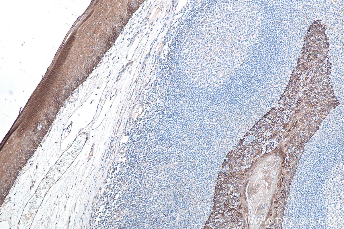 Immunohistochemical analysis of paraffin-embedded human tonsillitis tissue slide using KHC0041 (CK8 IHC Kit).