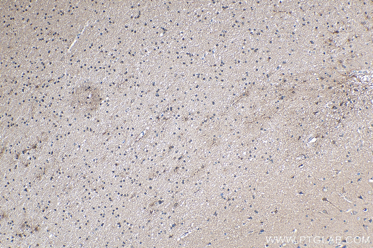 Immunohistochemical analysis of paraffin-embedded human gliomas tissue slide using KHC0325 (CKBB IHC Kit).