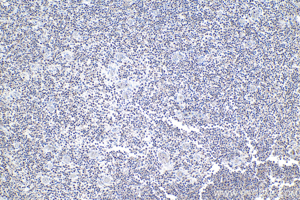 Immunohistochemical analysis of paraffin-embedded human colon cancer tissue slide using KHC1123 (CLEC12A IHC Kit).