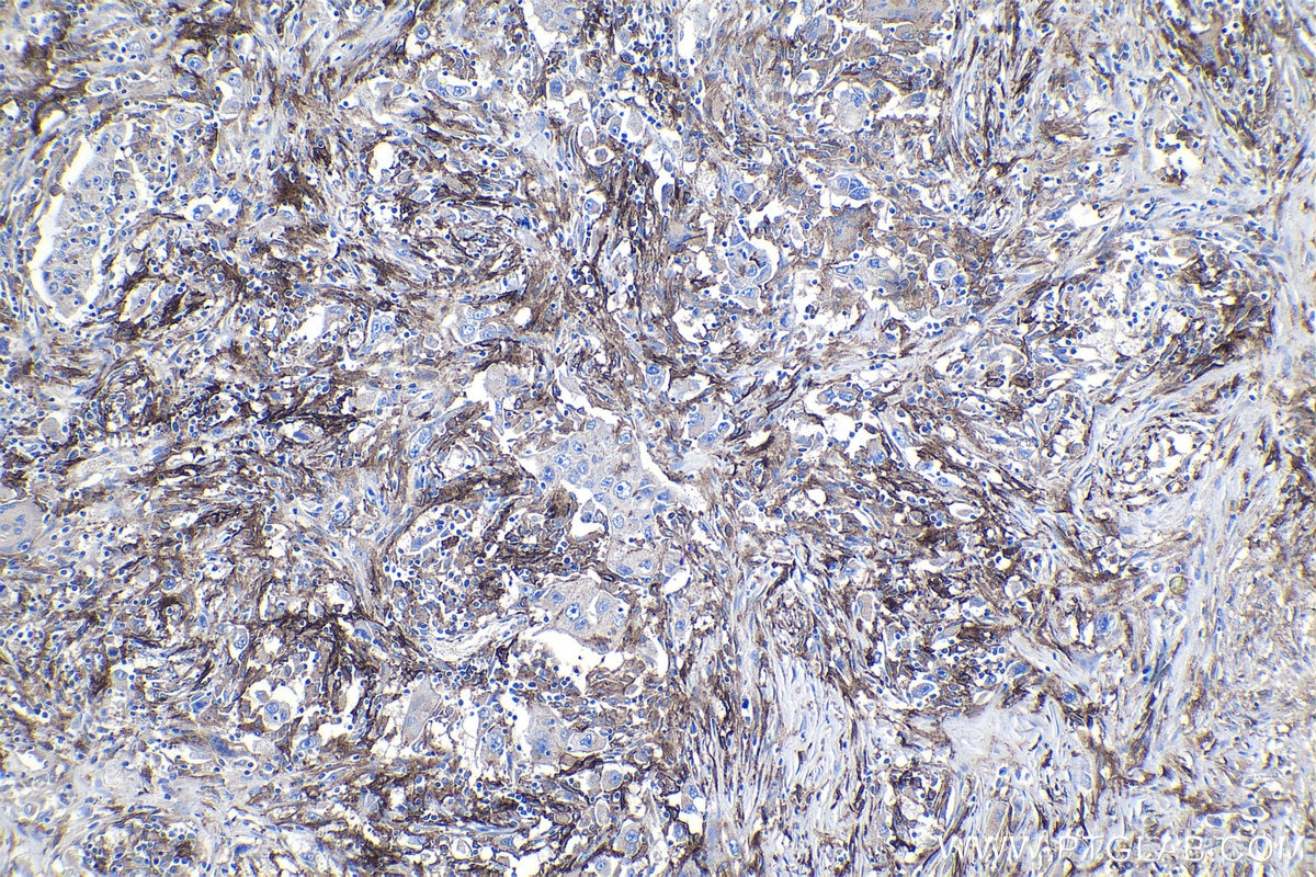 Immunohistochemical analysis of paraffin-embedded human lung cancer tissue slide using KHC1127 (CLEC4M IHC Kit).